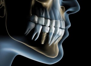 x-ray of dental implant in face illustration