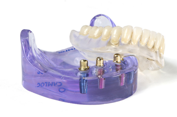 a visual representation of all on 4 implant bridges