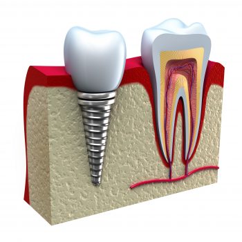 Anatomy of healthy teeth and dental implant in jaw bone