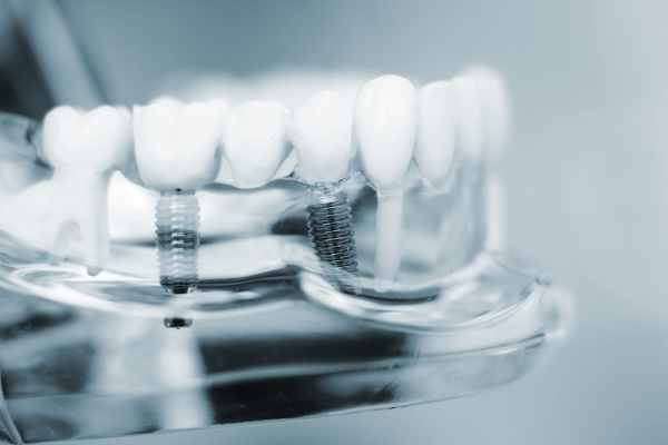a visual representation of dental implants