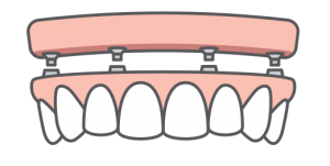 Full-Arch Replacement Illustration