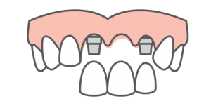 Single-Multi Tooth Replacement Illustration