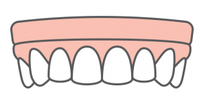 Implant Dentures Illustration