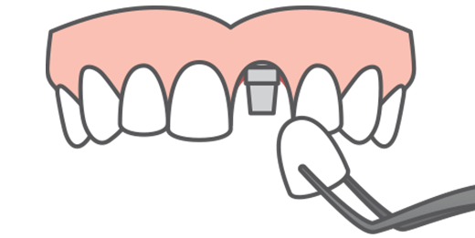 single tooth replacement illustration