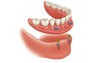 snap on dentures illustration