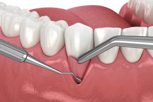 soft tissue graft or gum grafting