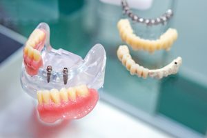 mini dental implants in model