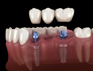 implant-supported dental bridge