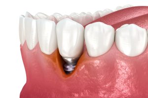 peri-implantitis gum recession