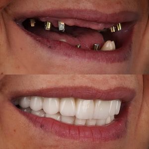before and after dental implant results
