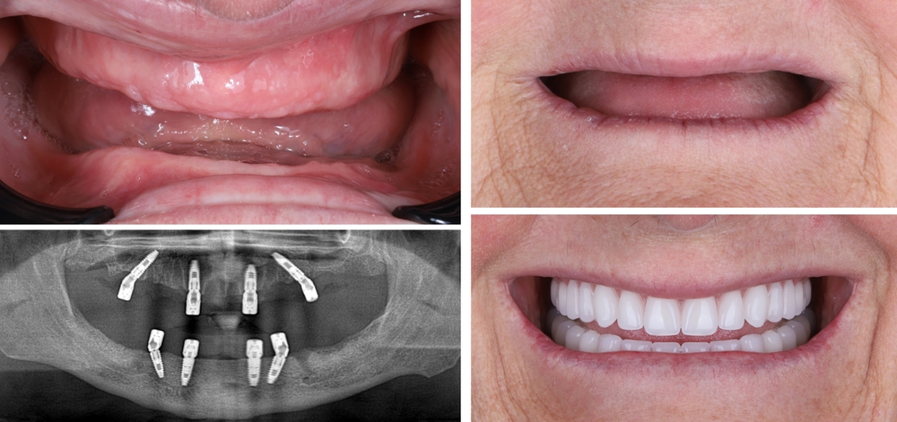 all on four dental implants