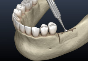 alveolar ridge augmentation