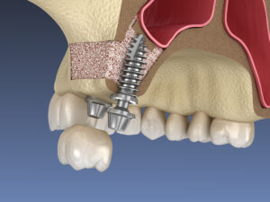 implant placement after a sinus lift